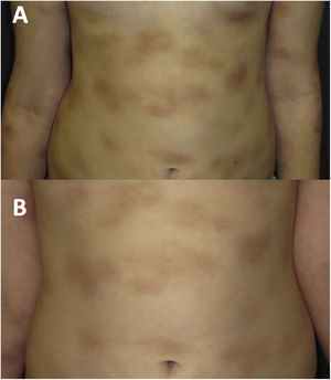 (A) The same girl with multiple infiltrative plaques on her skin before treatment with imatinib; (B) The same patient on treatment with imatinib at 20 months of follow-up.