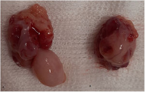 (A) Right tonsil measuring 3 × 2 cm with a polypoid overgrowth measuring 1.5 cm (length) × 1 cm (thickness). (B) Left tonsil with normal morphology measuring 2.5 × 2 cm.