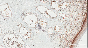 Immunohistochemistry. Staining with monoclonal antibody D2-40: positive in the endothelia of lymphatic structures (original magnification, ×40).