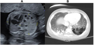 Antenatal ultrasound (A) and postnatal CT (B) images of CPAMs type 2 in the left inferior lobe.