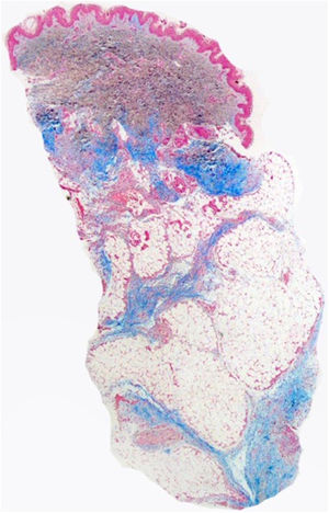 Biopsy sample of a cutaneous lesion in the patient. Alcian blue stain evincing mucin deposition.