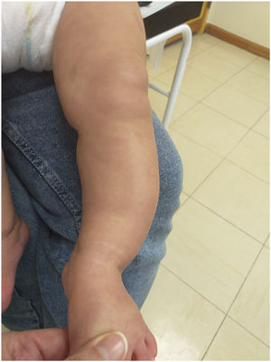 Left lower extremity asymmetry with pronounced bowing.