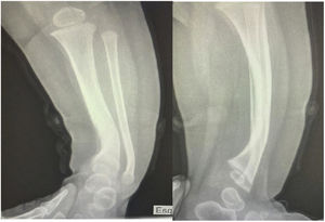 Cortical thickening and narrowing of the medullary canal suggestive of tibial dysplasia with congenital pseudarthrosis.