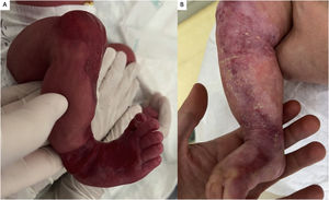 (A) An S-shaped area of localized absence of skin accompanied by first toenail dystrophy and small erosions in both feet. (B) CLAS healed completely after 5 months of local wound care.