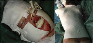 Suprathel applied over blistering lesions, wrapped with fat gauze and dry dressings, over different body surfaces in the face (left) and chest/back (right).