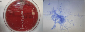 (A) Growth of dry white colonies after 48 h of incubation at 37°C on trypticase soy agar with 5% sheep blood, subsequently identified by MALDI-TOF mass spectrometry and 16S rRNA gene sequencing. (B) Modified Ziehl-Neelsen staining using 0.5% hydrochloric acid for decolorization. The branching bacilli did not stain faintly red or fuchsia (partially acid-fast bacilli) because 1% sulfuric acid was required, but not available at the time of diagnosis.