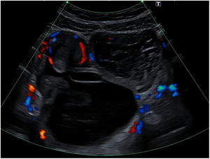 Doppler ultrasound of the abdomen revealing a cystic lesion with fluid and solid components and calcifications.