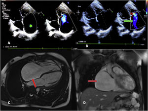 A) Doppler echocardiogram. Four-chamber view. The chief finding was the dilation of the right atrium (RA) (2D planimetry area, 47.8 cm2; mean value for an adult, 11.43 cm2) (green asterisk). B) Severe tricuspid insufficiency, with visualization of regurgitation jet reaching the dome of the RA (green arrow). C) Magnetic resonance imaging. Significant dilation of the RA in the 4-chamber and coronal views (red arrows). No delayed enhancement or evidence of intracardiac thrombi.