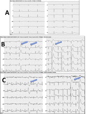 Bruce protocol treadmill test. A) Baseline stage with junctional rhythm at a rate of 42 bpm. Absence of atrial activity. B) Initial stage, frequent polymorphic ventricular asystole (blue arrows). C) Maximum stress stage, with heart rate at approximately 100 bpm (50% of predicted value) with persistence of frequent ventricular asystole (blue arrows).