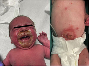 The infant was irritable and presented with yellow or honey-coloured crusts around the mouth and purulent discharge from the umbilicus and conjunctivas.