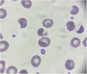 Peripheral blood smear with pyknocytes and blister cell (original magnification ×1000).