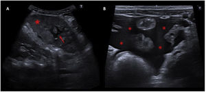 Abdominal ultrasound of the left hypochondrium. A image shows an enlarged spleen (13mm) for the patient's age, with heterogeneous echogenicity (red star). In addition, there were seen geographical areas with well-defined hypoechogenic borders inside the spleen (red arrow), due to ischaemia. B image demonstrates moderate amount of intra-abdominal free fluid (red asterisks).