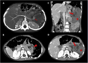 Contrast-enhanced abdominopelvic-CT in arterial phase (A) and portal venous phase (B–D). A image in the arterial phase exposes the splenic artery looping in its final portion at the level of the splenic hilum (red arrow). B image with an anterior displacement of the tail of the pancreas due to torsional traction (red arrowhead). C, D images shows a heterogeneous nodular area fatty content in the splenic hilum compatible with a twisted hilum (red arrow), and an enlarged homogeneously hypodense spleen in relation to massive infarction (red star).