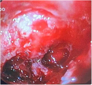 Duodenal ulcer with active bleeding.