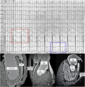 Top. Electrocardiogram conducted at the time the exercise challenge test was interrupted due to chest pain 8 min after starting. ST segment elevation measuring 3 mm in V2–V3 leads and 1 mm in V4 (red rectangle around V2–4), and 1–2 mm ST segment depression with T wave inversion in leads V5 and V6 (blue rectangle around V5–6), compatible with ischaemia in the region supplied by the anterior descending artery (ADA). The pattern normalised completely after 4 min of rest. Bottom. Three different views from the same coronary CT angiography showing myocardial bridging, 8 mm in length and 4.5 mm in width, in the medial segment of the ADA (white arrows). The course of the ADA leaves the surface of the heart to tunnel into the myocardium of the left ventricle in the different views. The rest of the coronary anatomy was normal.