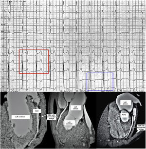 Top. Electrocardiogram conducted at the time the exercise challenge test was interrupted due to chest pain 8 min after starting. ST segment elevation measuring 3 mm in V2–V3 leads and 1 mm in V4 (red rectangle around V2–4), and 1–2 mm ST segment depression with T wave inversion in leads V5 and V6 (blue rectangle around V5–6), compatible with ischaemia in the region supplied by the anterior descending artery (ADA). The pattern normalised completely after 4 min of rest. Bottom. Three different views from the same coronary CT angiography showing myocardial bridging, 8 mm in length and 4.5 mm in width, in the medial segment of the ADA (white arrows). The course of the ADA leaves the surface of the heart to tunnel into the myocardium of the left ventricle in the different views. The rest of the coronary anatomy was normal.