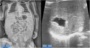 Radiological findings before abdominal drainage. A: shows central crowding of the bowel loops secondary to moderate ascites. B: shows a focal cystic lesion in segment iva of the liver, compatible with extravasation.