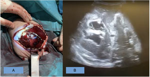 Association of clinical and imaging features. A: shows the difference between the right liver (presence of cyst resulting from parenteral nutrition and superficial bursting of the liver with hypoperfused areas) and left liver (normal appearance). B: shows the intraparenchymal cysts and free fluid.