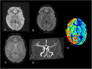 Magnetic resonance imaging at the level of the basal ganglia. A) diffusion sequence, B) FLAIR sequence, C) gradient echo sequence and D) TOF angiography revealing no abnormalities. E) Decreased blood flow in left hemisphere with preservation of left basal ganglia in ASL perfusion sequence. ASL, arterial spin labelling: FLAIR, fluid-attenuated inversion recovery; TOF, time of flight.