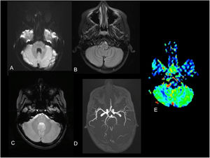 Magnetic resonance imaging at the level of the cerebellar hemispheres. A) diffusion sequence, B) FLAIR sequence, C) gradient echo sequence and D) TOF angiography revealing no abnormalities. E) Decreased blood flow in right cerebellar hemisphere in ASL perfusion sequence. ASL, arterial spin labelling: FLAIR, fluid-attenuated inversion recovery; TOF, time of flight.