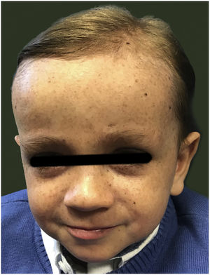 Face of the patient at age 2 years.