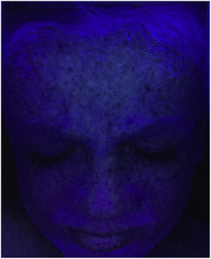 Lesions caused by expossure to sunlight visualised with UV light (courtesy of Javier del Boz González).