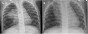 Persistent infiltrate in the right upper lobe: (A) age 1 year; (B) age 2 years.
