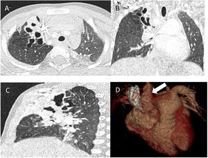 Bronchiectasis in the right upper lobe: (A) axial plane; (B) coronal plane; (C) sagittal plane; (D) right aortic arch.
