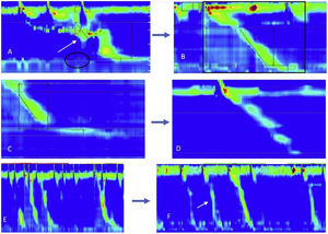 Patient 1 (A), (B): female patient in whom the follow-up assessment evinced improvement of symptoms, and the HROM at diagnosis (A) showed a hypotensive sphincter tone with tertiary contraction waves, with the patient requiring several swallowing attempts to move the bolus. The follow-up manometry (B) showed a normal lower oesophageal sphincter and a decrease in tertiary contraction waves, and the patient was able to push the bolus appropriately with a single swallow, with visualization of a peristaltic wave. Patient 2 (C), (D): male patient whose symptoms were stable at the time of the follow-up visit, in whom the follow-up HROM (D) did not evince any significant differences compared to the HROM assessment at diagnosis (C). Patient 3 (E), (F): female patient that reported worsening of symptoms in the follow-up visit, with more severe dysphagia and coughing upon consumption of liquids. The follow-up HROM (F) evinced an increase in tertiary contractions.