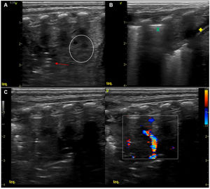 Ultrasound scan at admission. 11 L linear array probe. Longitudinal plane in left posterior hemithorax. (A–C) Large area of consolidation spanning 6 intercostal spaces (EIC) at the base and 3 cm deep, with hepatization and dynamic air bronchogram (red arrow), with Doppler signal and minimal pleural effusion (yellow + sign). Notice the hyperechoic artefact usually generated by the change in acoustic impedance between the subcutaneous tissue and the lung tissue, pleural line (green × sign). (A) Hypoechoic lesions in the consolidated parenchyma with hepatization (white circle), an early sonographic feature associated to parenchymal necrosis.