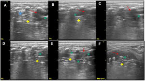 Lung ultrasound at 10 days of admission. 11 L linear array probe. (A–E) Longitudinal plane in left posterior hemithorax (LLL): area of consolidation (red arrows) containing static hyperechoic linear artefacts (green × sign and yellow + sign). This artefact is generated by the change in impedance between the consolidated lung parenchyma and the pneumatocele. (A) This must be differentiated from the features generated by residual pneumothorax (blue star): Pleural line, absence of lung sliding and presence of A-lines. (E) The pneumatocele is surrounded by consolidated parenchyma with hepatization (green × signs). (F) Transversal plan in left posterior lung base: hepatization of parenchyma corresponding to area of consolidation (red arrow) containing hyperechoic artefacts (green × sign) followed by smaller hyperechoic linear artefacts (yellow + sign).