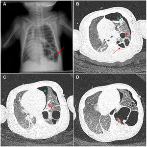 (A) Chest radiograph (anteroposterior decubitus ): multiple gas-filled cavitary lesions in LLL in the same location as the sonographic lesions compatible with pneumatocele (red arrows). (B–D) Chest CT scan with contrast. Lung window: multiple cystic lesions involving nearly the entire left lower lobe of diameters of up to 5 cm compatible with postinfectious cavitation (red arrows). Intact left upper lobe. Left pneumothorax with drainage tube (green × signs).