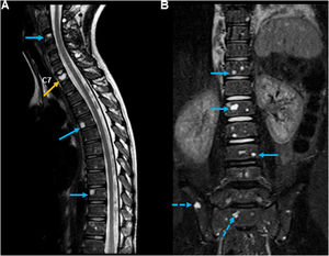 (A) Sagittal T2-weighted MRI scan of the cervical spine confirming the presence of multiple lesions involving the vertebral bodies, with hyperintense signals (blue arrows) suggestive of compression fracture at the level of C7 (orange arrow). (B) Coronal T2-STIR sequence image of the upper thoracic and lumbosacral spine revealing lesions with the same characteristics (arrows) and sacroiliac involvement (dashed arrows).
