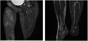 Magnetic resonance images of the lower extremities showing findings compatible with extensive soft tissue involvement in the form of cellulite and fasciitis in the anterior and medial compartment of the thigh and the medial compartment of the leg to the dorsum of the foot.