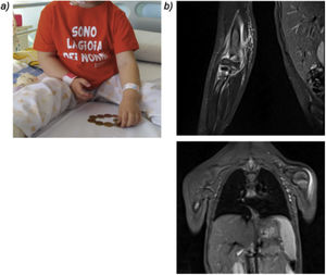 (a) Patient functional impairment and pain in the right elbow on day 5 of admission. (b) Whole body MRI images showing features compatible with fasciitis in the right arm, elbow and forearm and a focus of mild fasciitis in the left deltoid.