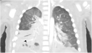 Chest CT scan with intravenous contrast. Necrotising pneumonia with empyema in the base of the right lung.