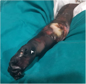Photograph. Macroscopic appearance of distal ischaemia in the right upper extremity with proximal progression and development of hard necrotic plaques.