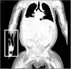Chest CT scan with intravenous contrast. Necrotising fasciitis in the right upper extremity with patchy myositis and extensive ischaemia of the extremities and trunk.