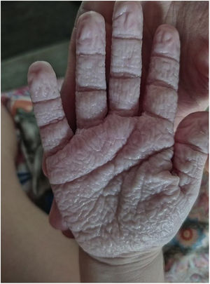 Whitish lesions in the palms of both hands and hyperwrinkling developed during bathing.
