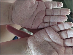 Whitish lesions in the palms of both hands and hyperwrinkling developed during bathing.