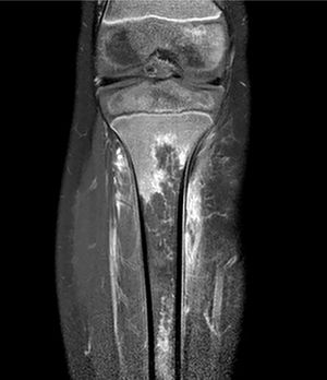 MRI of the lower extremity. Coronal T1-weighted fat saturated post-gadolinium image showing an irregular geographic area of no enhancement in the proximal metaphysis and diaphysis of the tibia due to a large bone infarct.