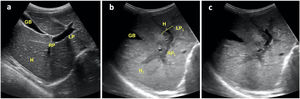 Oblique transverse plane of the hypochondrium obtained with a convex probe at the level of the epigastrium, showing: a) Homogeneous echogenicity of hepatic parenchyma (H) with normal appearance of right portal vein (PD), left portal vein (PI) and gallbladder (VB) in a healthy patient; b) Heterogeneous echogenicity of hepatic parenchyma (H1), right portal vein (PD1) and left portal vein (PI1) with a hypoechoic halo (M) in patient with acute myeloid leukaemia; c) Similar image in the same patient, without references to allow better visualization of the aforementioned structures.