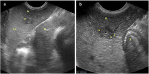 Oblique longitudinal plane of the left hypochondrium obtained with a convex probe at the level of the epigastrium, showing: a) Hepatic parenchyma at the level of the left lobe (LHI) with transversal sections of echo-poor periportal haloes of larger (M) and smaller (m) size; b) Enlargement of previous image with measurement of the diameter of one of the periportal haloes. Stomach (E).
