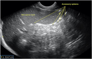 Longitudinal plane of the spleen obtained with a convex probe at the level of the left hypochondrium evincing splenomegaly (length of long axis of spleen, 8.47cm; upper limit of normal for age, 8cm) and several accessory spleens in the lower pole of the hilum, suggestive of malignancy.
