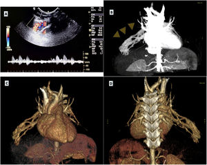 Complex pulmonary arteriovenous malformation (AVM) in the right middle lobe in a boy aged 18 months. (A) Thoracic POCUS with a stronger Doppler signal along the right thoracic wall at the level where a murmur was heard on auscultation. (B) CT angiogram showing the pulmonary AVM (arrowheads). (C and D) 3D reconstruction of CT scan provides both anterior and posterior views of the intricate pulmonary AVM, illustrating its complexity.