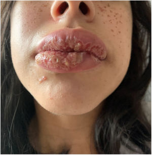 Ulcerations of the oral mucosa and lip oedema.