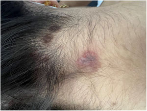 Scalp and neck ulceration and post-inflammatory hyperpigmented spots.