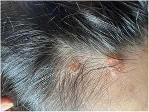 Vesiculobullous lesions with secondary impetiginization.