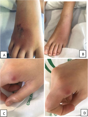 Evolution of the lesion in the dorsum of the right foot. (A) Active phase. Erythematous plaque with poorly defined borders, warm to the touch, with central purpuric bruise-like component and livedo reticularis, indicative of vasculitis. It was associated with hyperaesthesia and pain on palpation and movement of the foot. In the sole of the same foot, there was a nodule measuring approximately 1×1cm with external signs of inflammation (not featured in image). There was also a plaque measuring approximately 5×3cm extending from the lower third of the left leg to the lateral malleolus, indurated, with poorly defined borders, warm to the touch and painful on palpation (not featured in image). (B) Lesion in remission. Erythema in the dorsum of the foot and residual allodynia. Resolution of the purpuric component and livedo reticularis. (C) and (D) Evolution of the nodular lesion in the 2nd finger of the right hand.