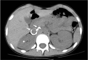 Computed tomography angiography image of the abdomen showing two saccular aneurysms in the right renal artery with gross calcifications in the wall (arrows) and decreased size of the ipsilateral kidney (asterisk).